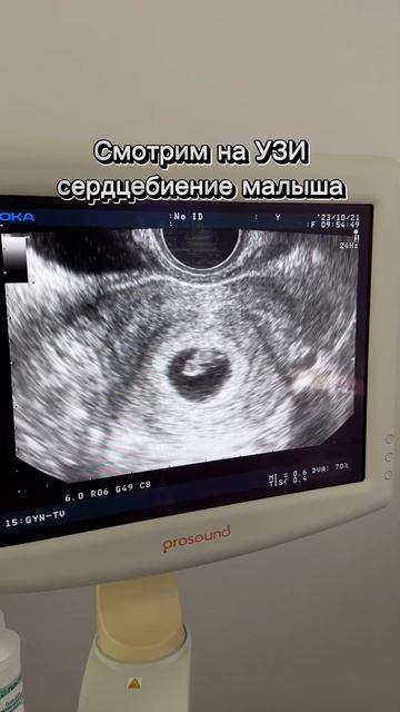 УЗИ, сердцебиение малыша после ЭКО#дети #бесплодие #уз? смотреть онлайн