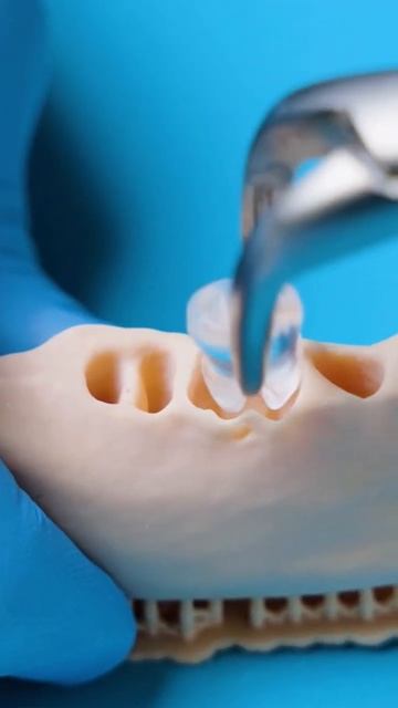 Пересадка зуба в Москве | аутотрансплантация зуба в Мо смотреть онлайн