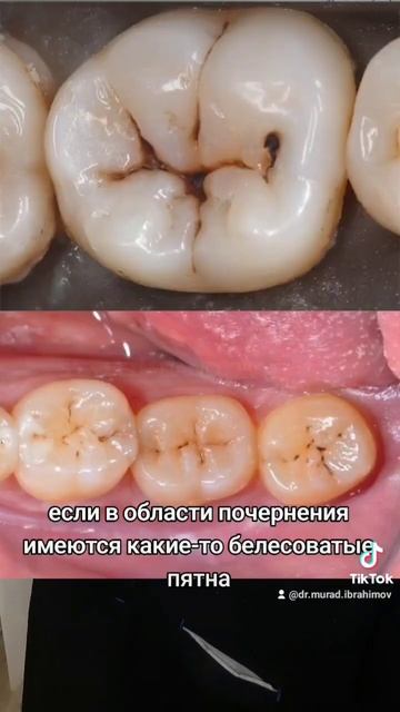 #зубнойкамень #зубнойналет #кариес #кариесзубов #стома