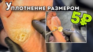 Внушающий размер мозоли которую боялись все. Специально приехал из другого города