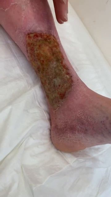 Не надо думать, что варикоз безобиден. А вот что может ? смотреть онлайн