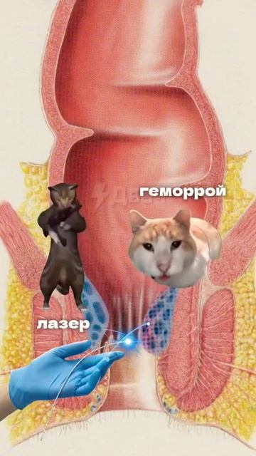 Как лечат геморрой