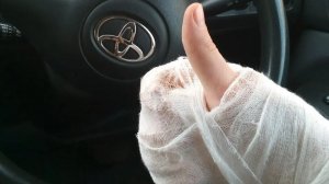 Эксперт рассказал можно ли управлять автомобилем со сломанной рукой в гипсе
