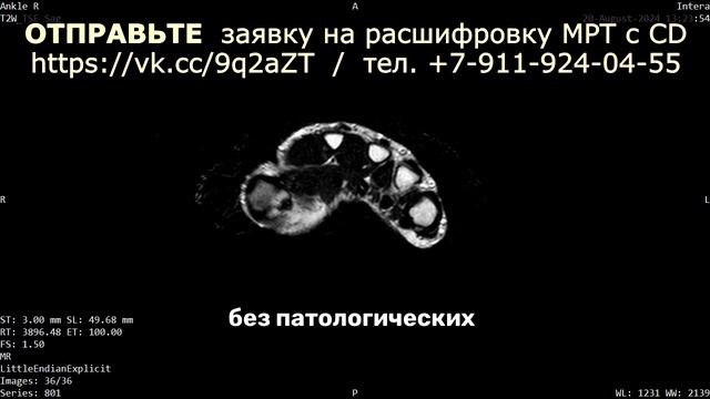 БОЛЬ В КИСТИ руки при АРТРОЗО АРТРИТЕ лучезапястного ?