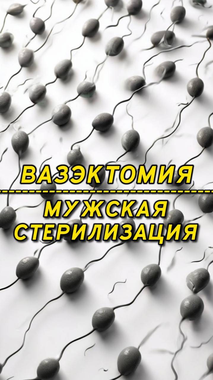 Вазэктомия или мужская стерилизация