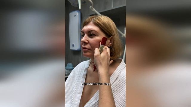 Круговая пластика лица и шеи: SMAS и платизмопластика