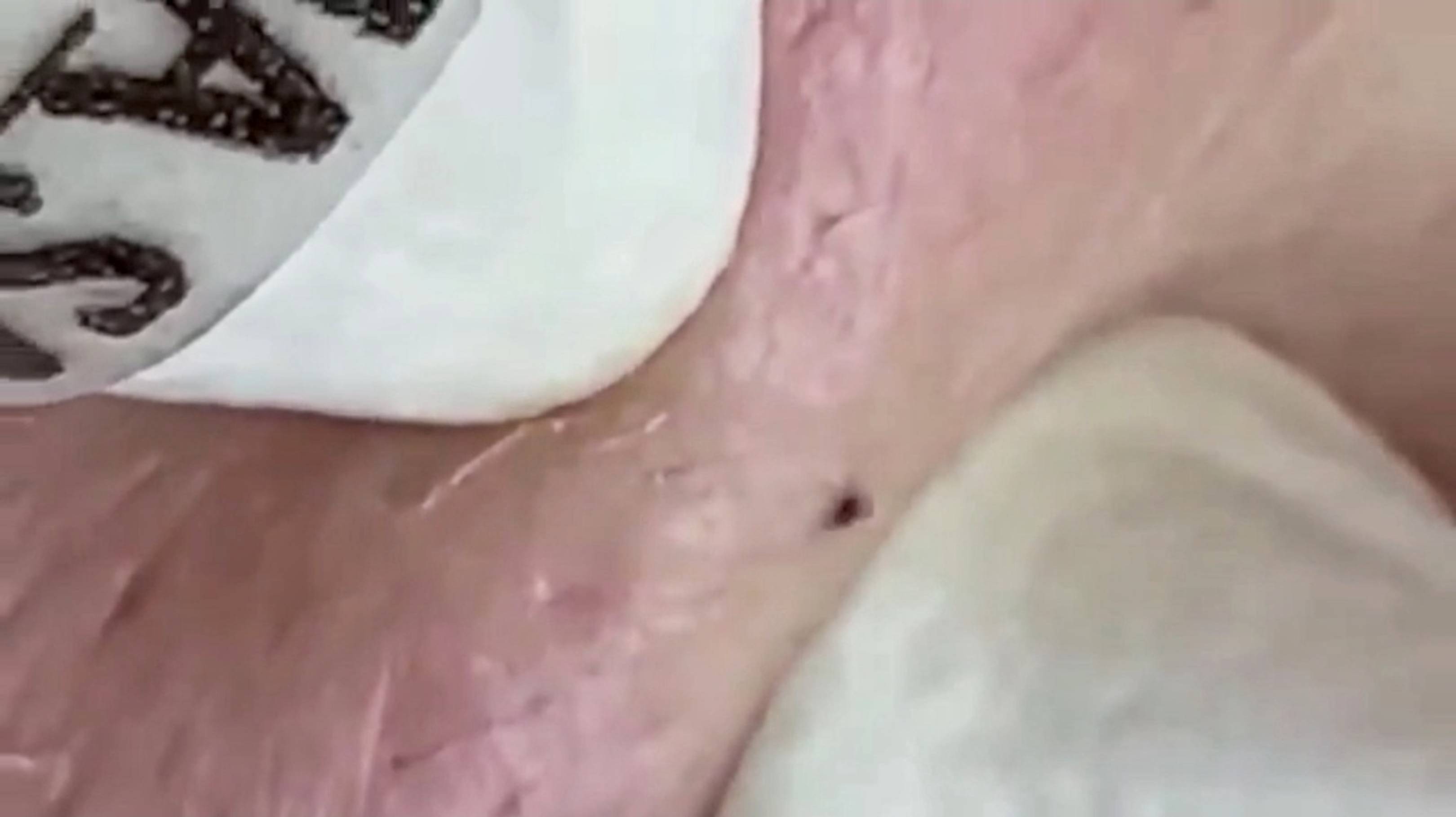 Симпатичные прыщи убрали мы сегодня смотреть онлайн