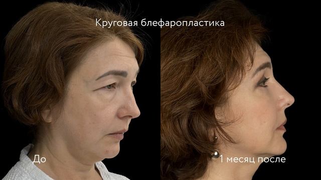 Круговая блефаропластика До и После: пластика верхних смотреть онлайн