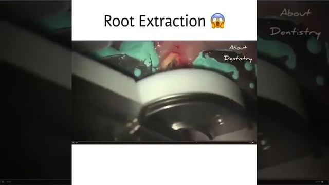 Шок! Новый способ удаление зубов 🇷🇺 Shock!  A new way to remove teeth🇺🇸 смотреть онлайн