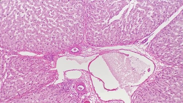 ЭТО быстро снизит ваш ХОЛЕСТЕРИН! Снижаем холестерин ? смотреть онлайн