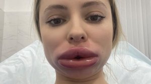 Жертва красоты или Как мне испортили губы в салоне! Подробности в ТГ: Aleksandrova_life