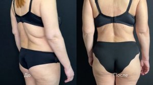 Бодилифт | Круговая подтяжка тела | Липофилинг ягодиц