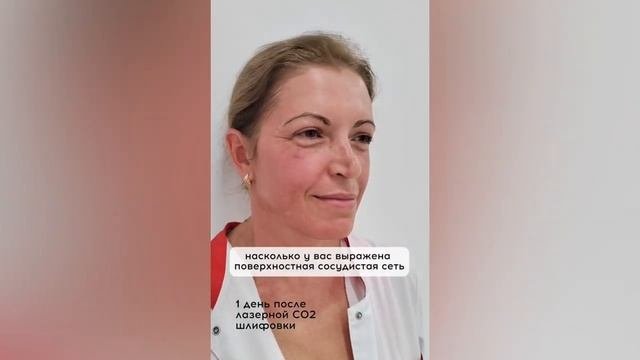 Реабилитация после лазерной шлифовки