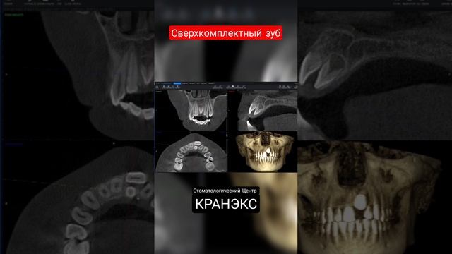 #сверхкомплектный #зуб у ребёнка смотреть онлайн