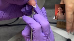 РЕБРИСТЫЕ НОГТИ (продольные борозды на ногтях)