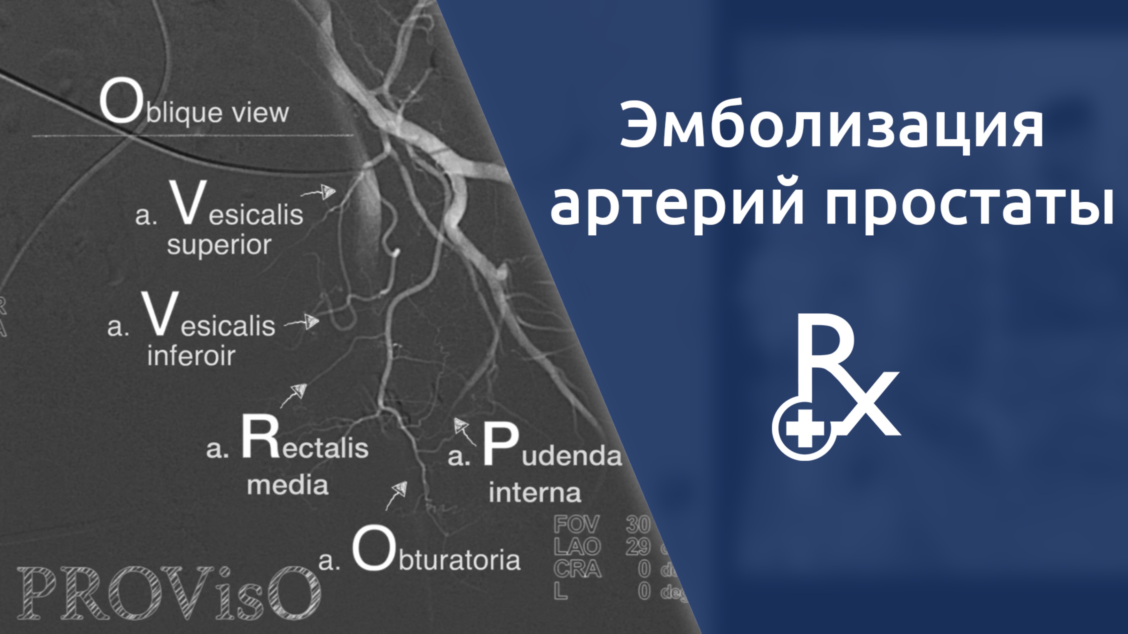 Эмболизация артерий предстательной железы