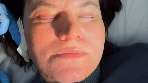 Лифтинг лица и шеи: четкий овал лица и красивая шея