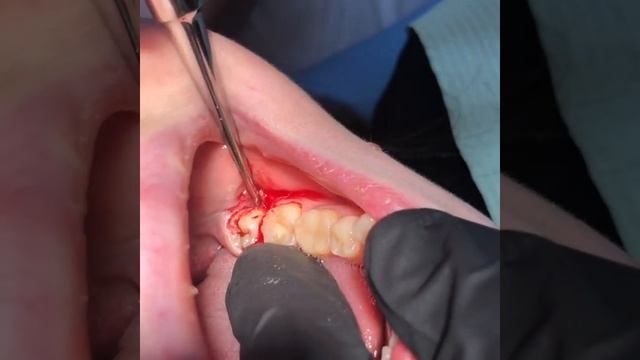 Удаление зуба мудрости смотреть онлайн