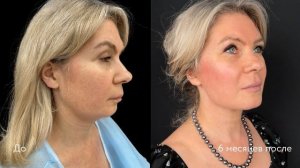 SMAS-лифтинг лица и шеи