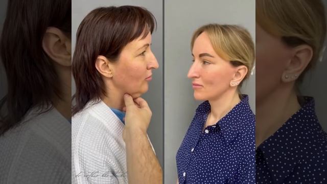 Омоложение лица и шеи. Доктор Артур Христенко смотреть онлайн