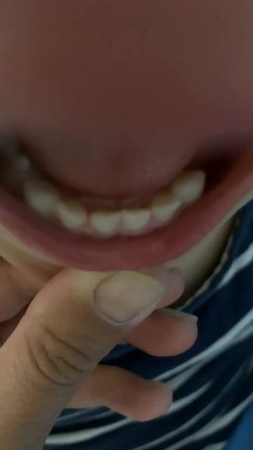 У ребёнка 2 ой ряд зубов 