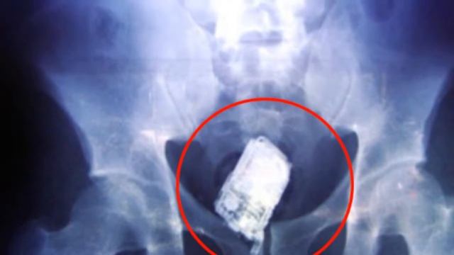 Топ 15 вешей которые были внутри людей смотреть онлайн