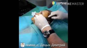 Нитевой лифтинг лица. Подтяжка нитями APTOS