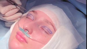 Блефаропластика верхних век с коррекцией асимметрии