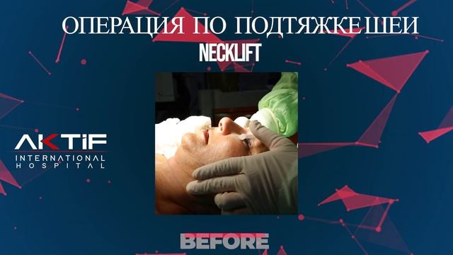 Aktif International - Операция по подтяжке шеи смотреть онлайн