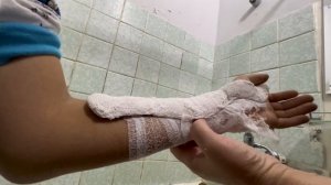 Сломал руку/ вывих кисти у Сайёдбека/ Снимаем гипс
