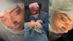 Верхняя блефаропластика: пластика верхних век До и По?