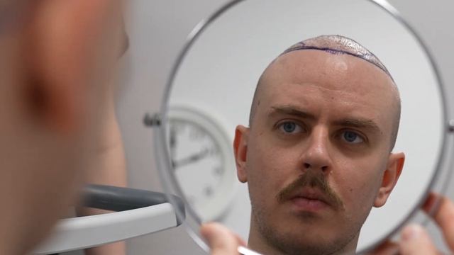 Моя вторая пересадка волос, подробнее некуда