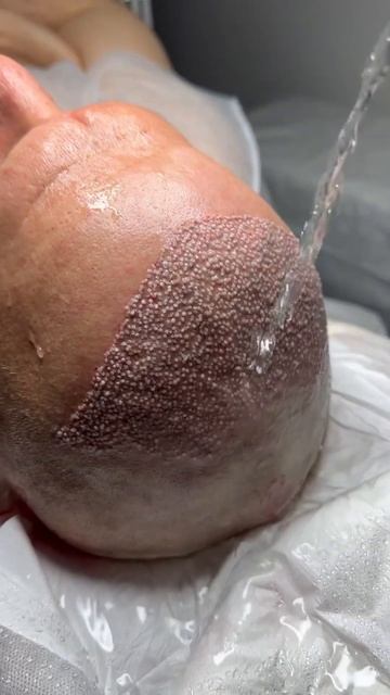 Пересадка волос после отлично операции #пересадкавол? смотреть онлайн