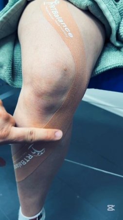 тейпирование колена для профилактики травм внутренних связок