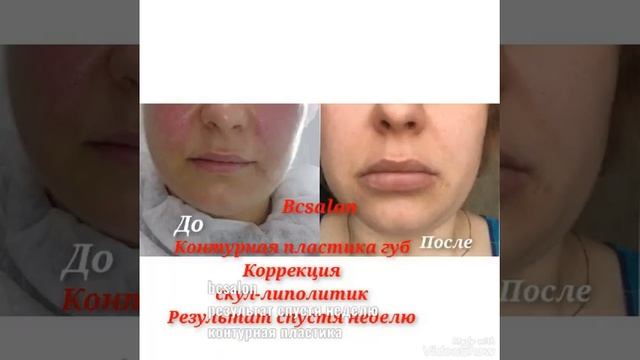 Контурная пластика губ|Обзор результат до и после инъ?