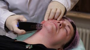 Morpheus 8: аппаратное омоложение и подтяжка лица