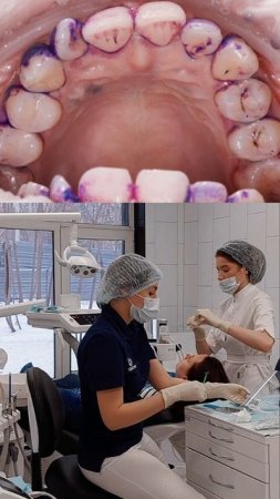 До и после гигиены — зубы не врут