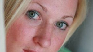 Как  убрать розацеа