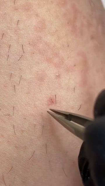 Вот так могут врастать волоски. Чтобы такого не было электроэпиляция в помощь  эпиляциякраснодар