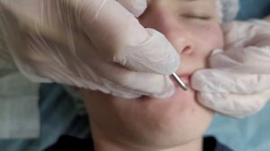 Удаление родинки под губой