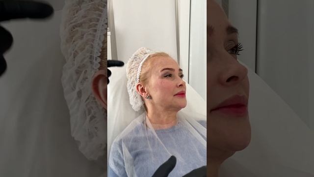 Коррекция ботулотоксином мимических морщин возле гла