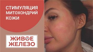 Даша после Микроигольчатого RF лифтинга + Эликсир Живое Железо наружное применение