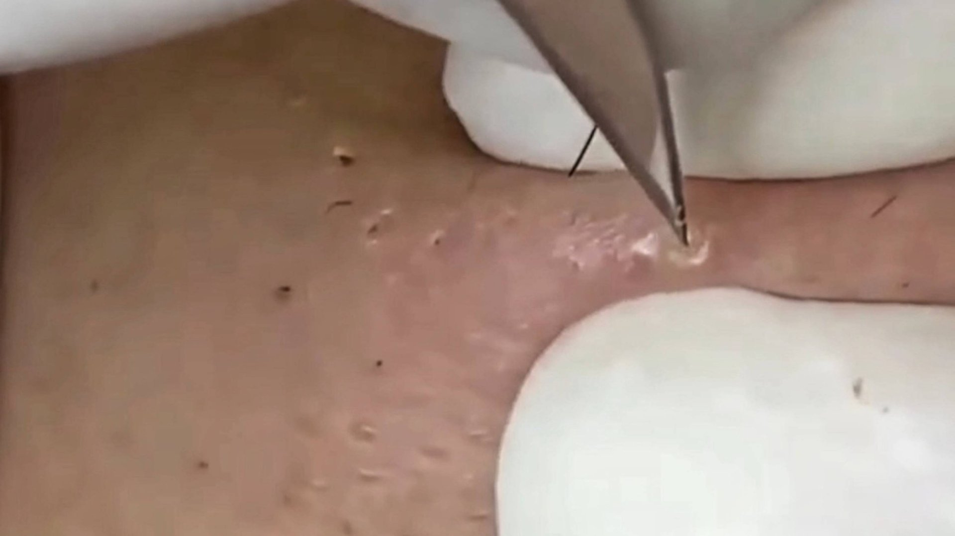 Увлекательное очищение кожи лица смотреть онлайн