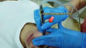 Алмазный пилинг