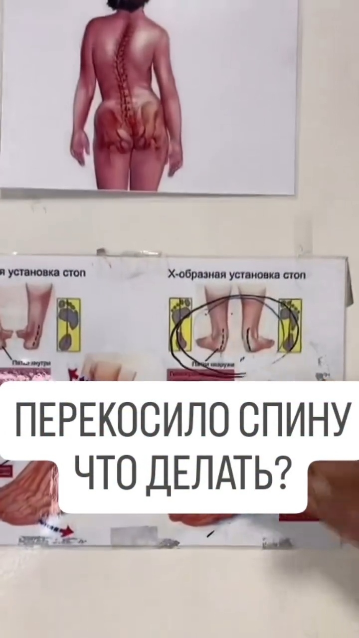 Как избавиться от последствий плоскостопия , перекос спины, таза, коленей, кривых ног #плоскостопие