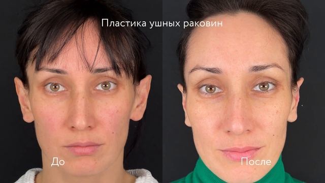 Отопластика или пластика ушных раковин: измени форму ? смотреть онлайн