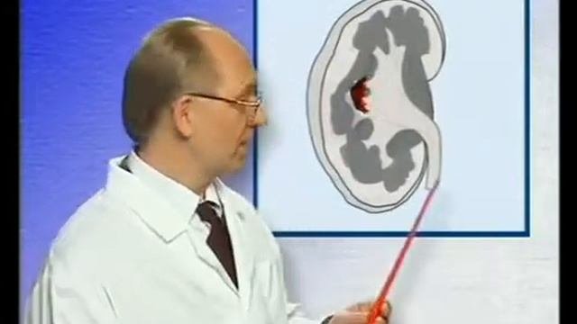 Удаление_камней_в_почках_без_операции_и_дробления_Поя