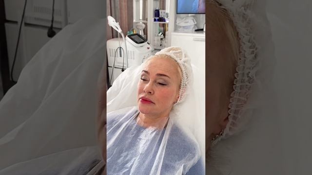 Коррекция ботулотоксином мимических морщин лба.