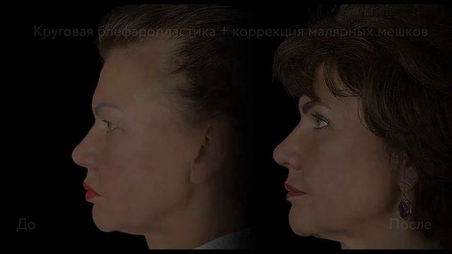 Хирургия верхних и нижних век | Коррекция малярных меш