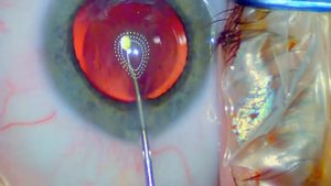 ICL STAAR - имплантируемые контактные линзы при кератоконусе и т.д.